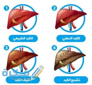 كم نسبة دهون الكبد الطبيعية 1 images 54