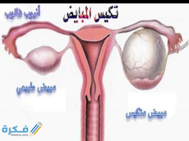 هل تكيس المبايض البسيط
