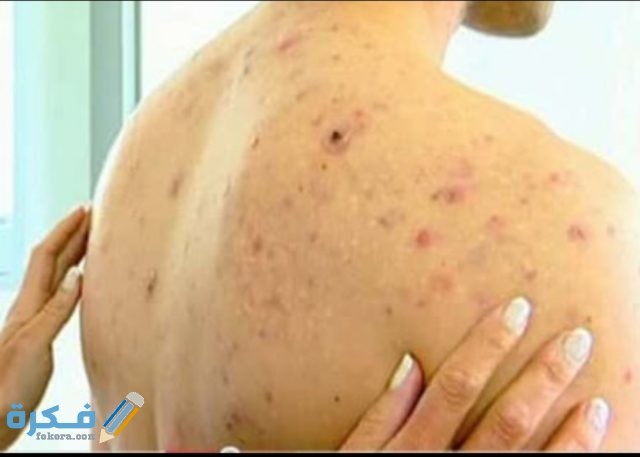 ظهور حبوب في الظهر