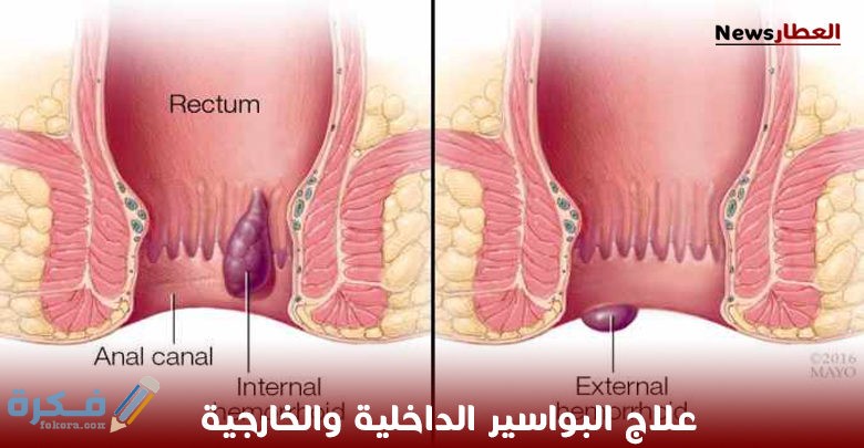 من جربت الحجامة للبواسير 1 البواسير الداخلية والخارجية 780x405 1