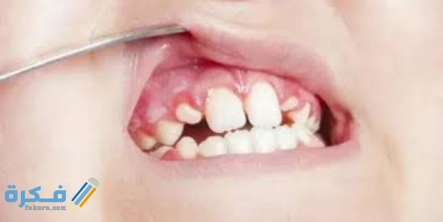 زوائد لحمية في الفم أسبابها وطرق علاجها