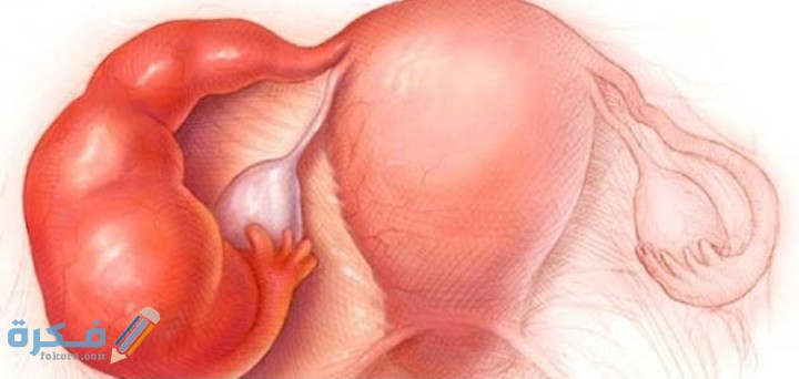 أعراض كيس على المبيض الأيمن وأنواع كيسات المبيض 1 IMG ٢٠٢١٠٢١٦ ٠٢٢٣٤٢