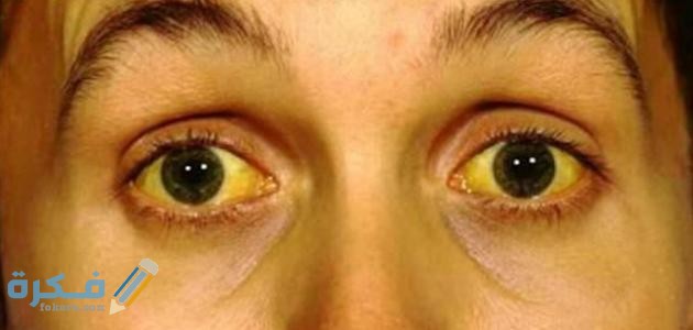 أعراض فقر الدم في العين 