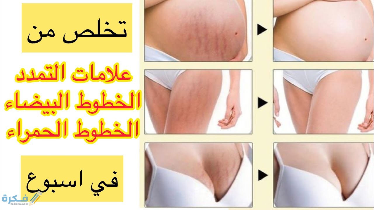 شرح خطوات التخلص من علامات التمدد الحمراء 1 خلطات طبيعيه للتخلص من علامات التمدد الحمراء