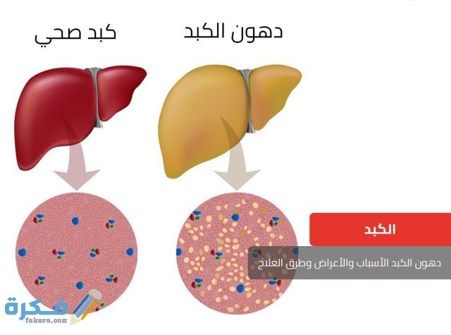 اسباب الإصابة بدهون الكبد 