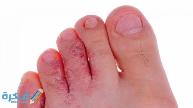 اسباب-فطريات-القدم