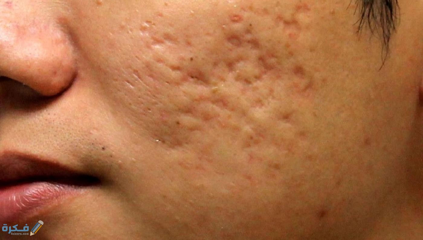 شرح خطوات التخلص من ثقوب الوجه 1 التخلص من ثقوب الوجه