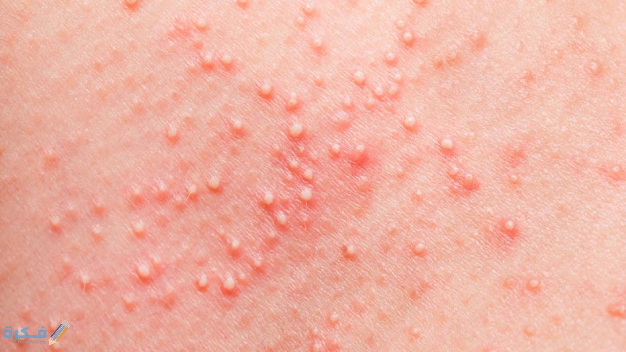 شرح خطوات علاج حساسية الوجه 1 بعض أنواع الأدوية لعلاج حساسية الوجه