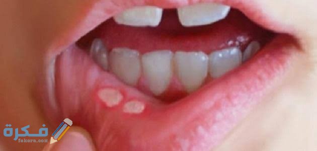 ما هو علاج فطريات الفم واللسان