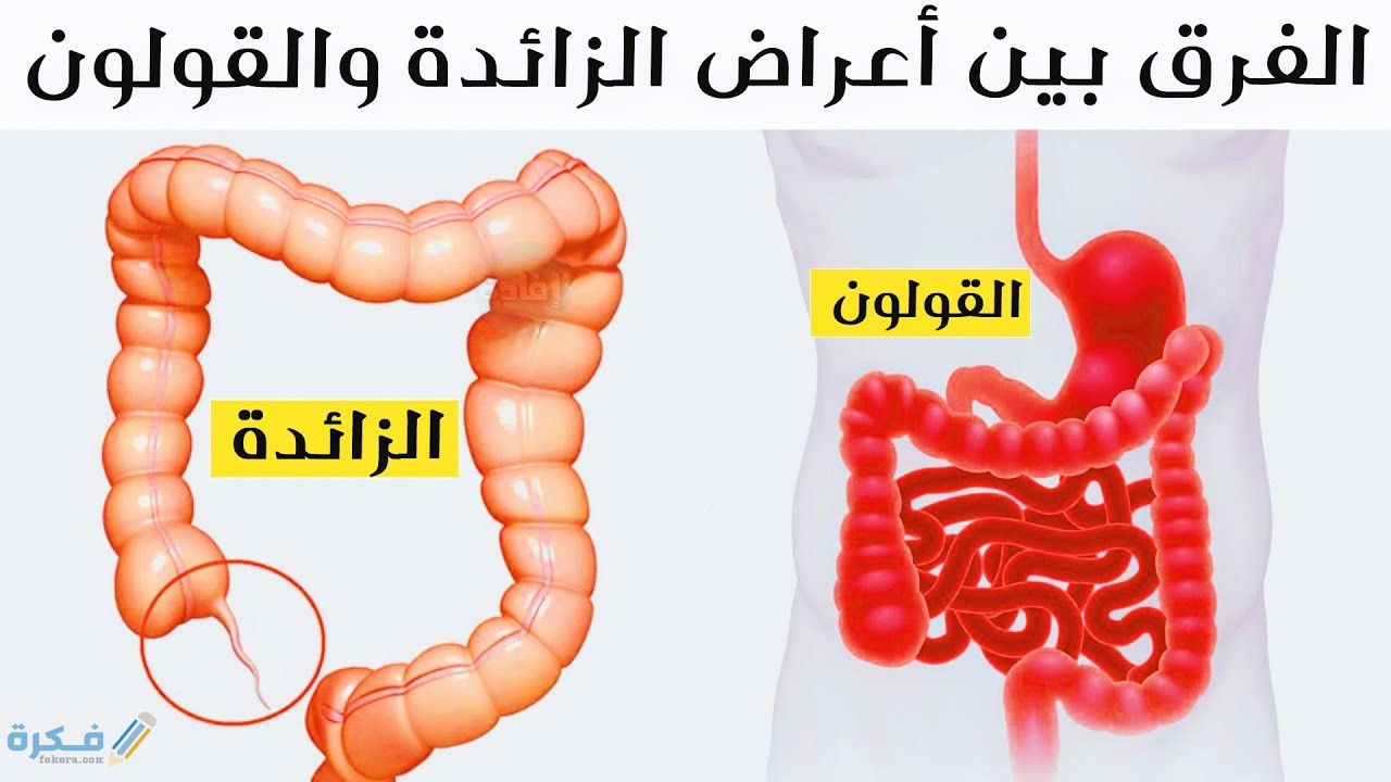 الفرق بين أعراض الزائدة والقولون 1 اعراض الزائدة الدودية