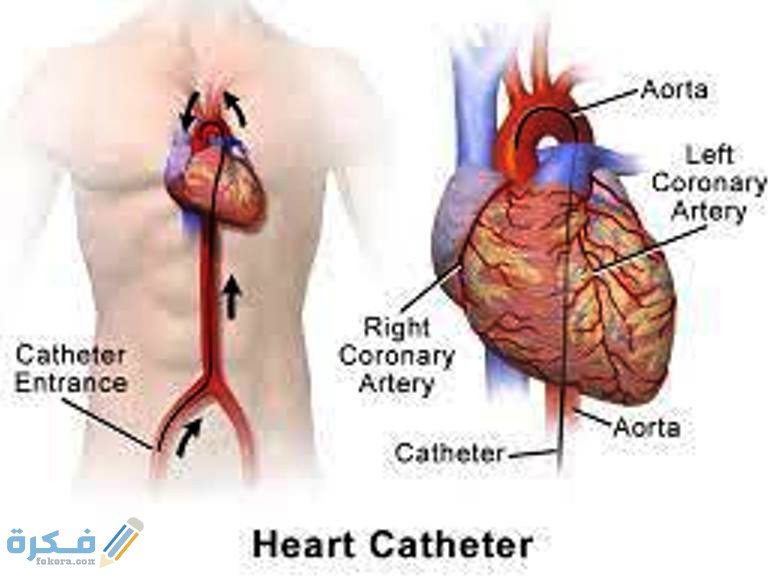 أهم شروط إجراء عملية قسطرة القلب 