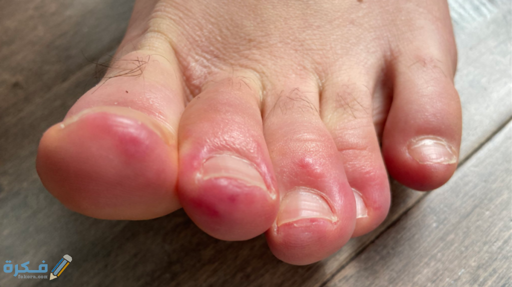 هل يوجد مرهم لعلاج تورم أصابع القدم في الشتاء