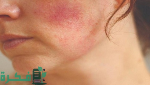 احسن كريم طبي لعلاج الحساسية والحكة في الوجه 1 هل يوجد كريم طبي لعلاج حساسية الوجه