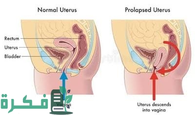 تجربتي مع عملية رفع المثانة 1 images 2022 11 22T233249.573