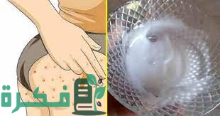 مرهم لإزالة حبوب المؤخرة