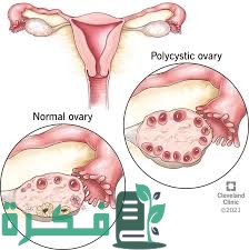 ما هي متلازمة تكيس المبايض 1 2400EAD9 D7E0 400B B19A A1B975DE6D39