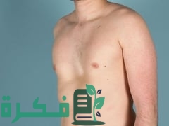 ما هي متلازمة مارفان 1 3ABB0F8D C6D5 4ECD 97E1 FEAE0D68D874