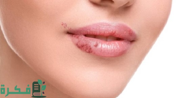 أفضل 5 أنواع مرهم لتقرحات الشفايف