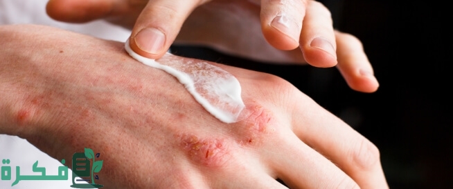 علاج حساسية الجلد من المنظفات