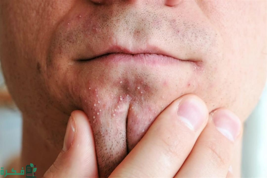 هل هناك علاقة بين ظهور الحبوب وممارسة الجنس