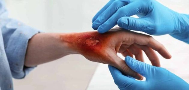 تقنية مبتكرة لعلاج الحروق والجروح الخطيرة عبر حقنة جلد جديدة 1 تقنية مبتكرة لعلاج الحروق والجروح الخطيرة عبر حقنة جلد جديدة