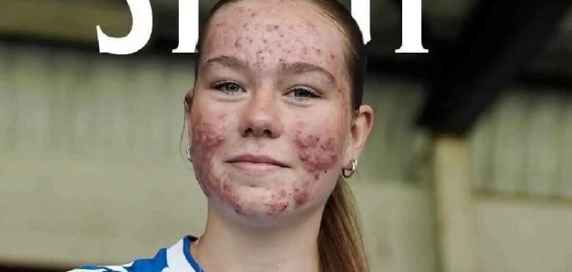 حبوب الشباب تعكر صفو فرحة لاعبة شابة في لحظة انتصارها 1 حبوب الشباب تعكر صفو فرحة لاعبة شابة في لحظة انتصارها