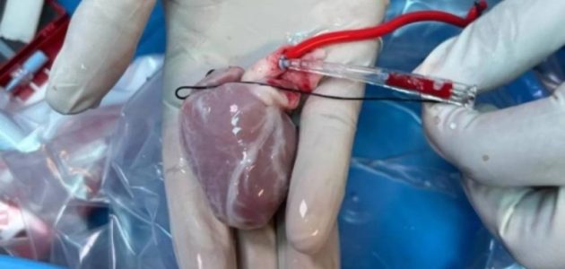 زراعة جزئية للقلب تفتح آفاق جديدة لعلاج الأطفال ذوي العيوب الخلقية 1 زراعة جزئية للقلب تفتح آفاق جديدة لعلاج الأطفال ذوي العيوب الخلقية